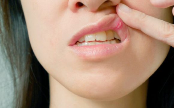 Стоматит и его основные причины