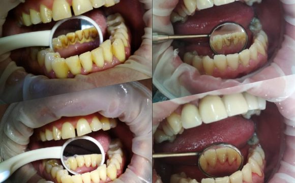 Профессиональная чистка полости рта