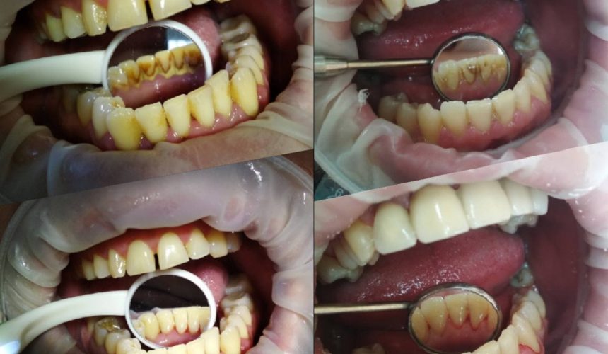 Профессиональная чистка полости рта