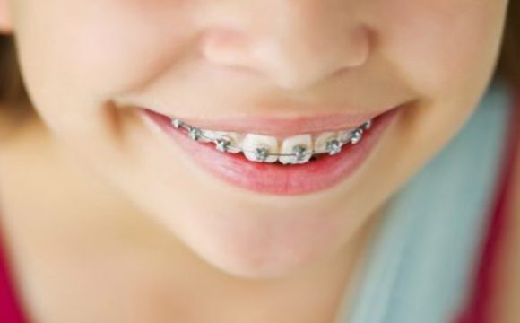 Уход за зубами с брекет-системой