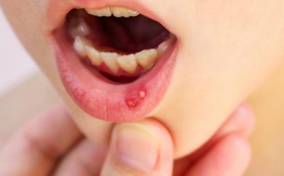 У ребенка – стоматит