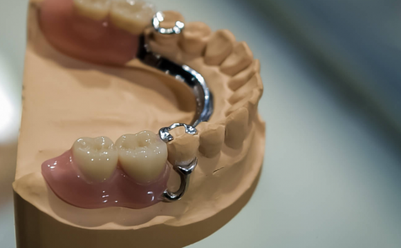 Бюгельный протез, его применение и способы фиксации