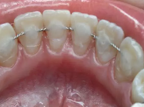 Применение метода «шинирования» для подвижных зубов