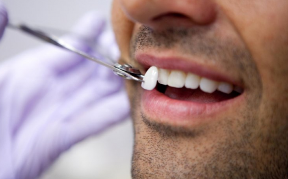 Виниры или брекеты для идеальной улыбки?