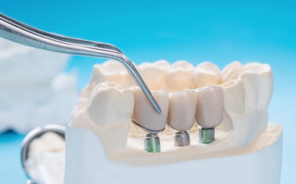 Когда применяется мини-имплантация зубов Когда применяется мини-имплантация зубов