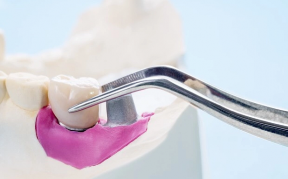 Какие виды несъемных протезов к услугам наших пациентов